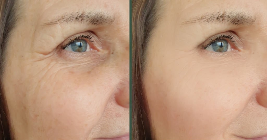 Refined skin results